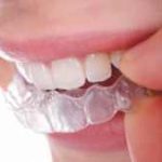 invisalign-disteli-300×163[1]