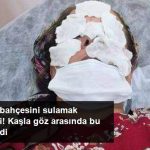 Fındık Bahçesini İlaçlamak İsterken Bu Hale Geldi